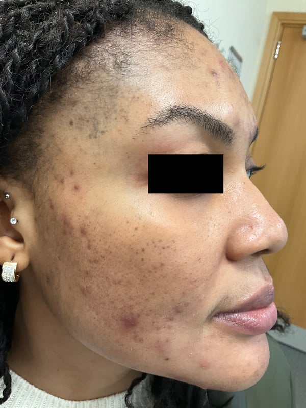 Close-up of cheeks with stubborn breakouts and brown spots pre-maintenance.