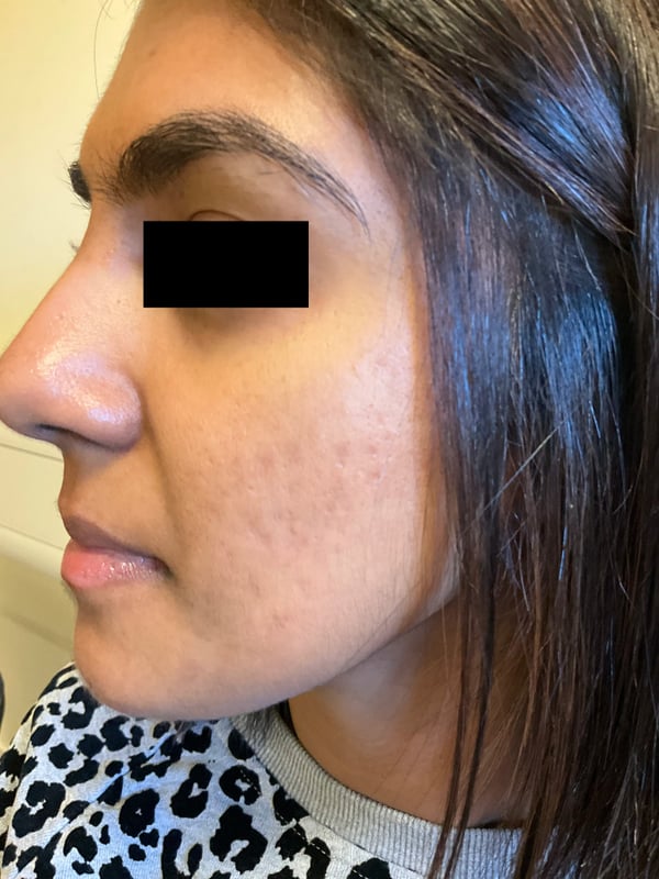 Profile with even tone and calmer skin after combined acne care.