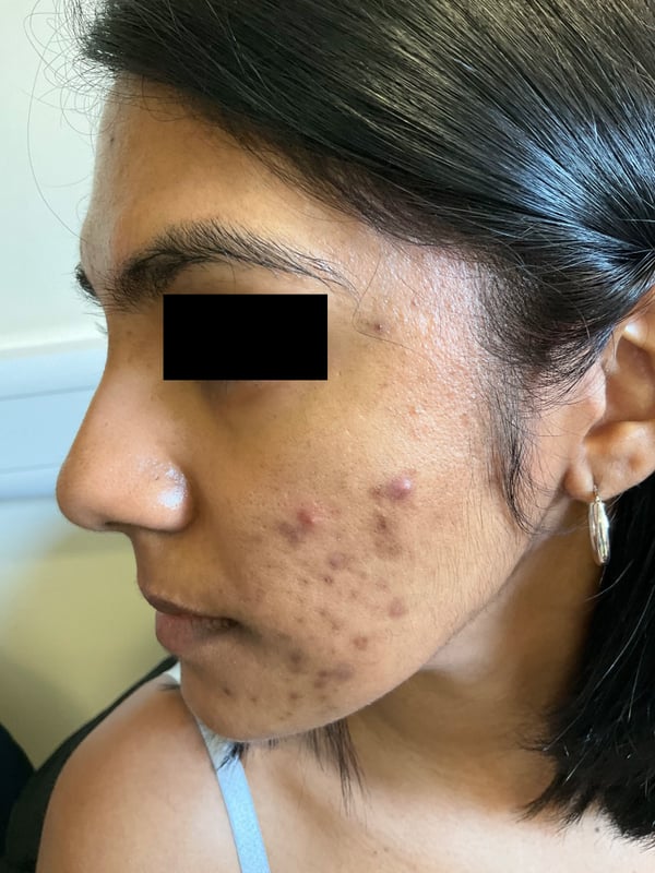 Profile with active breakouts and dark macules pre-treatment.