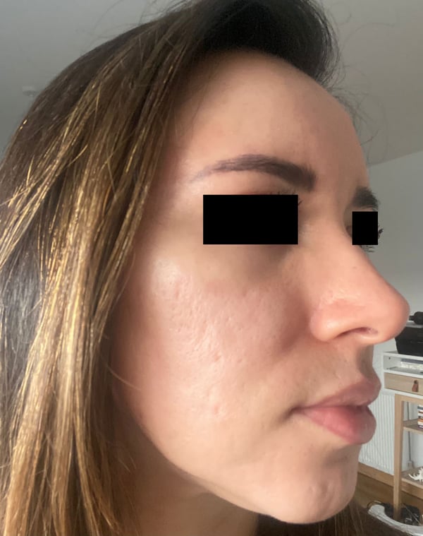 Cheek close-up with refined texture and brighter tone after remodeling.