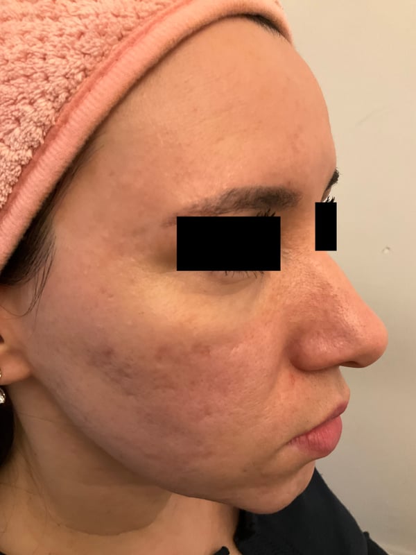 Cheek close-up with rolling scars and discoloration pre-remodeling.