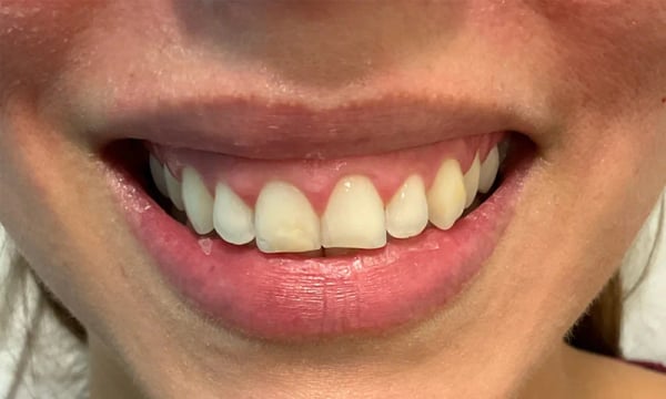 Full smile showcasing excess gum display prior to botox.