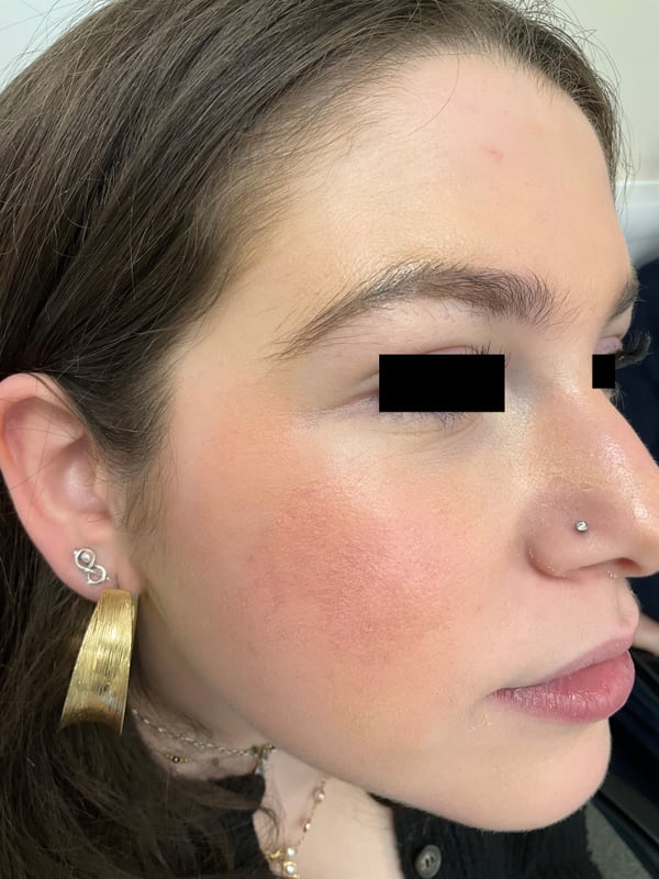 Face showing dramatic clearing and normalized skin texture after isotretinoin treatment.