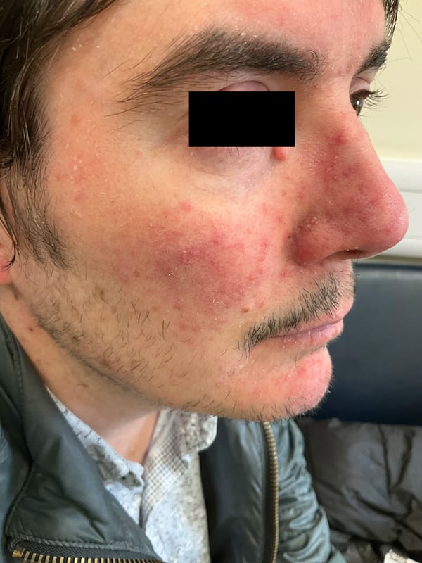 Cheeks with diffused redness and papules prior to rosacea therapy.