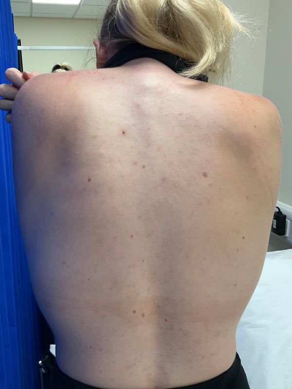 Same area showing significantly reduced breakouts and clearer skin after truncal acne protocol.