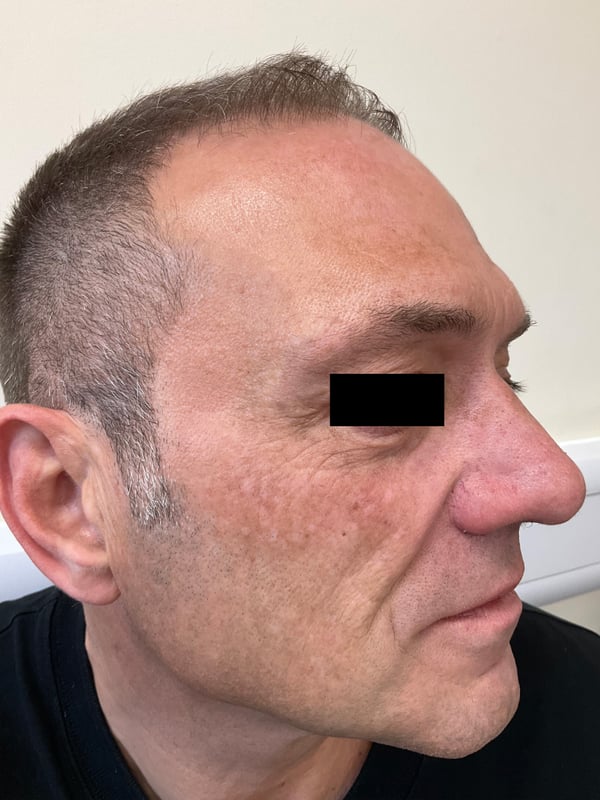Same area displaying significant repigmentation and restored skin tone after treatment.